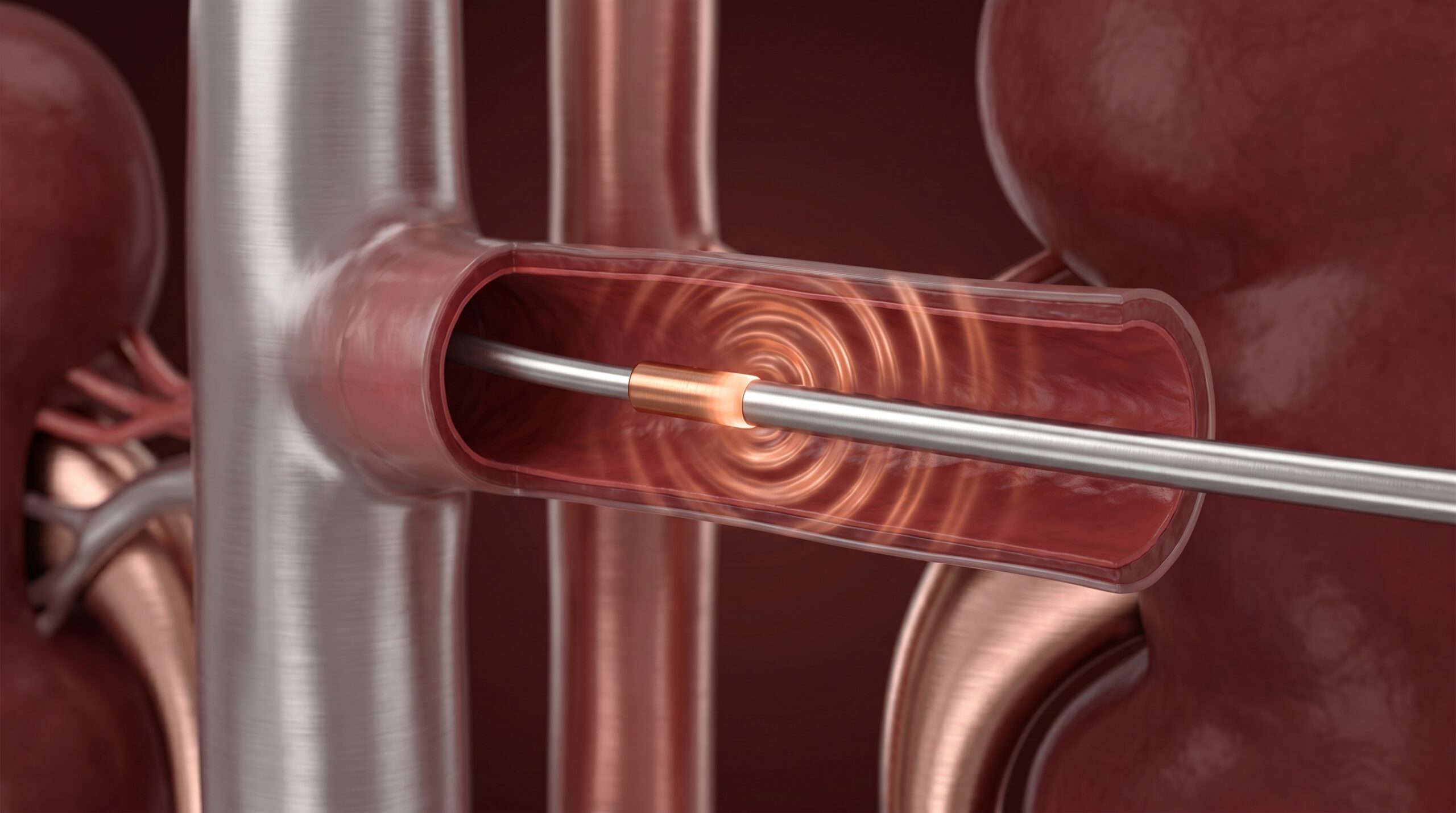 Renal Denervation for Resistant Hypertension in 2026